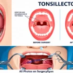 Tonsillectomy Surgery in Adults vs Children: Differences, Recovery, Benefits & Risks