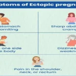 Ectopic pregnancy